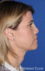 Revision Rhinoplasty - Case 513 - After