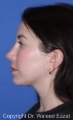 Revision Rhinoplasty - Case 514 - After