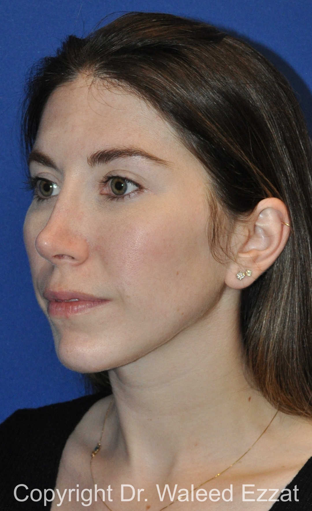 Revision Rhinoplasty Patient Photo - Case 514 - before view-1