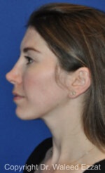 Revision Rhinoplasty - Case 514 - Before