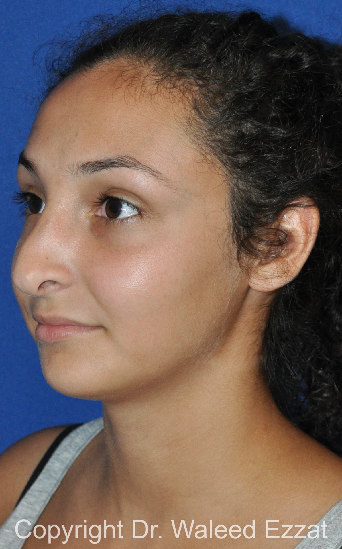 Revision Rhinoplasty Patient Photo - Case 515 - before view-1
