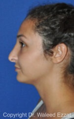 Revision Rhinoplasty - Case 515 - Before