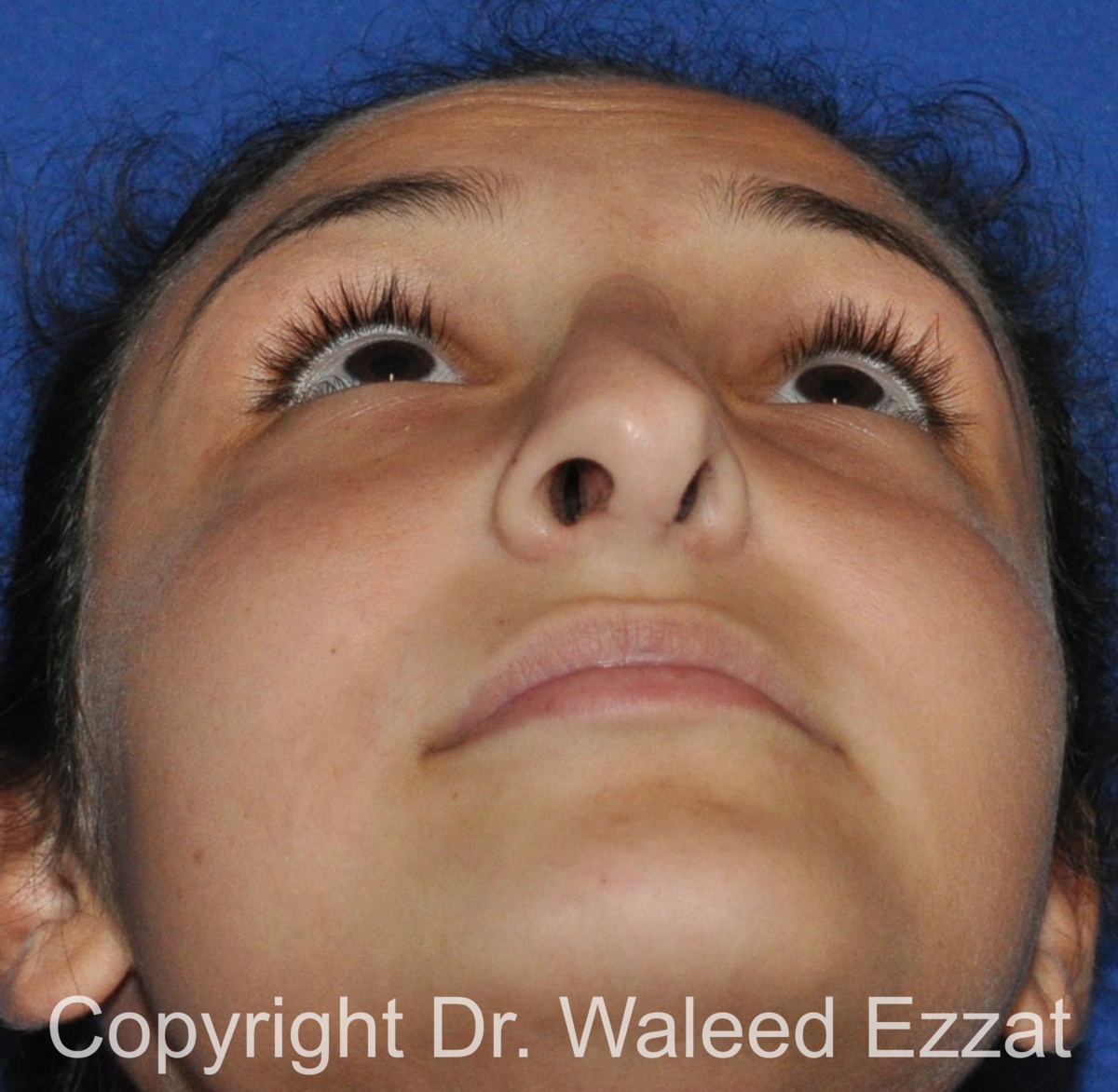 Revision Rhinoplasty Patient Photo - Case 515 - before view-3