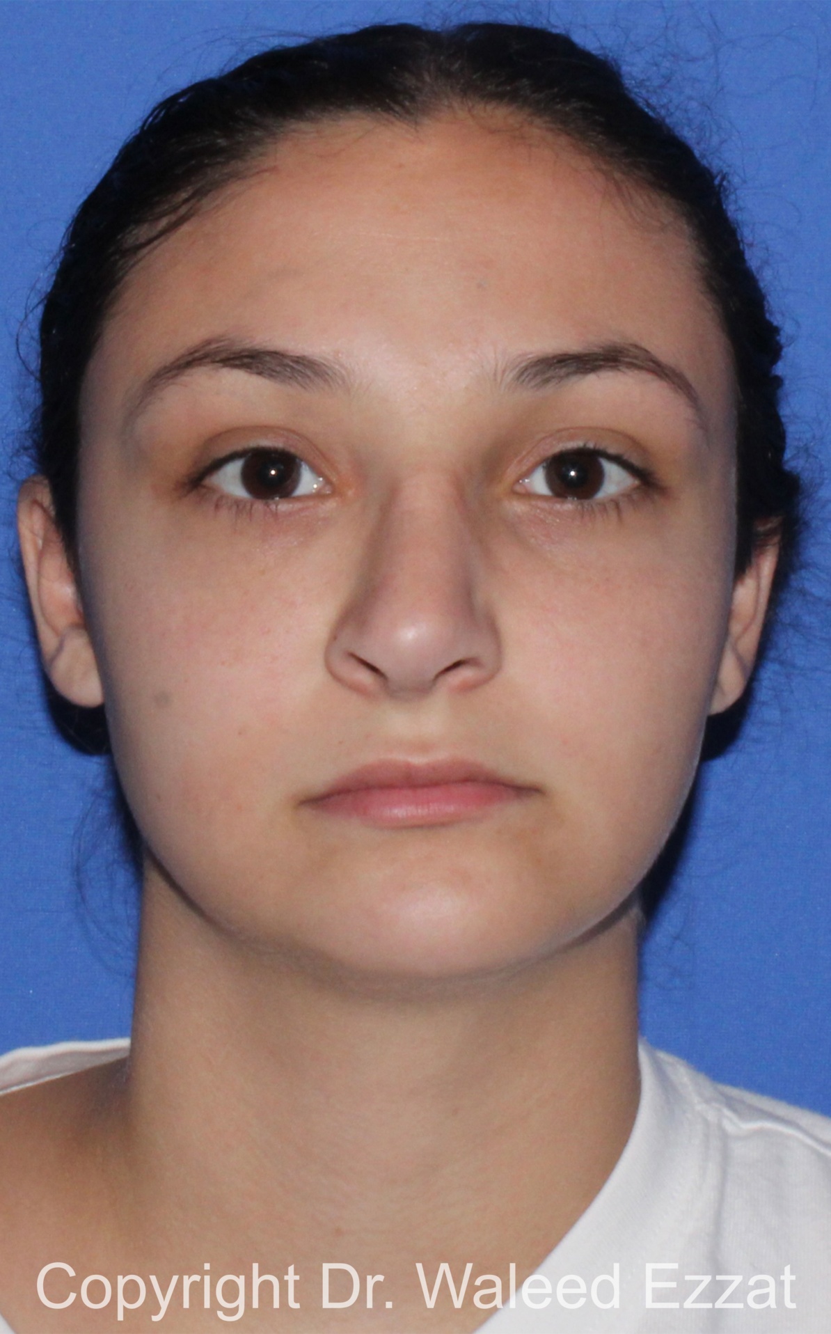 Revision Rhinoplasty Patient Photo - Case 515 - after view-2