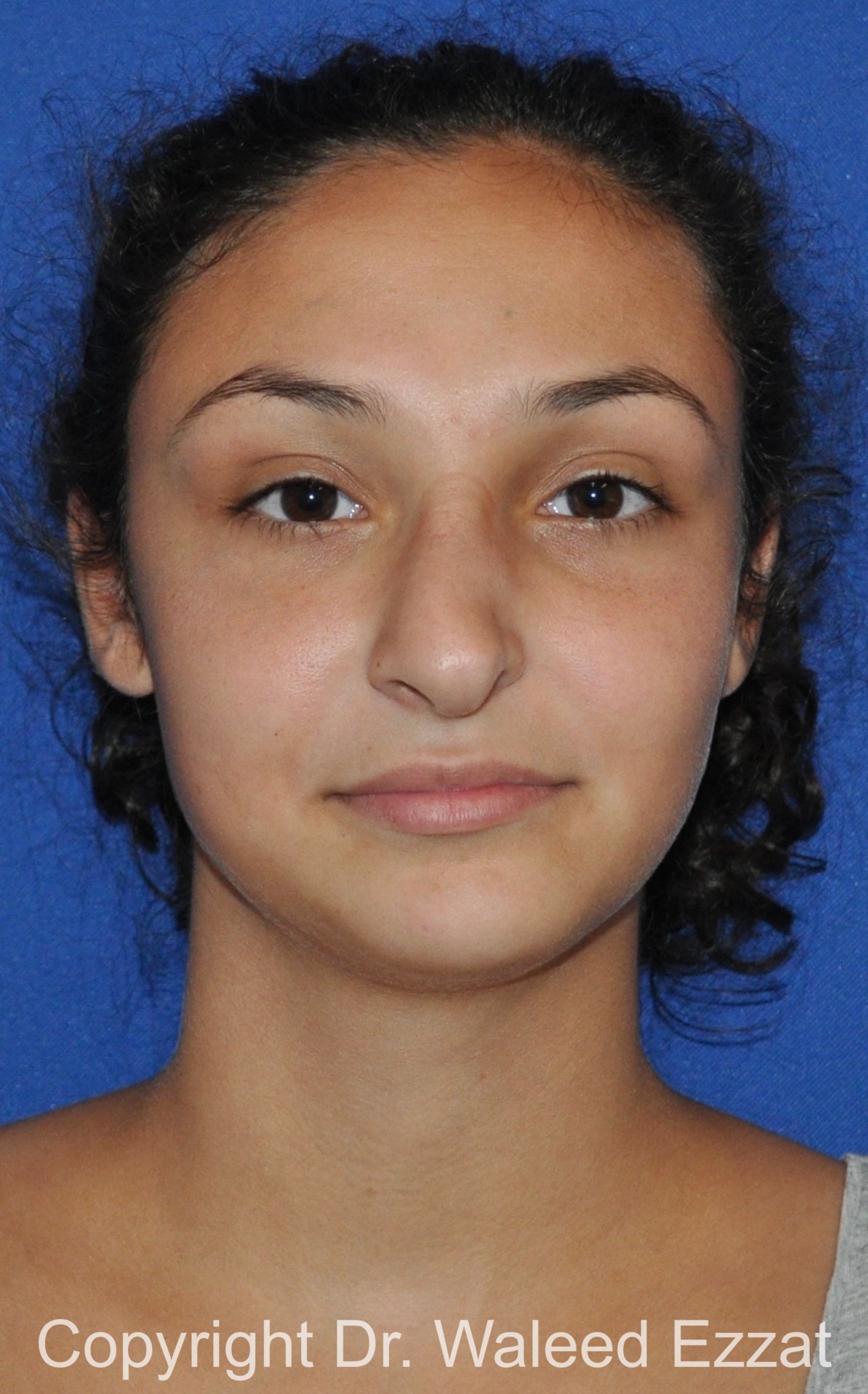 Revision Rhinoplasty Patient Photo - Case 515 - before view-2
