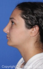 Revision Rhinoplasty - Case 515 - After