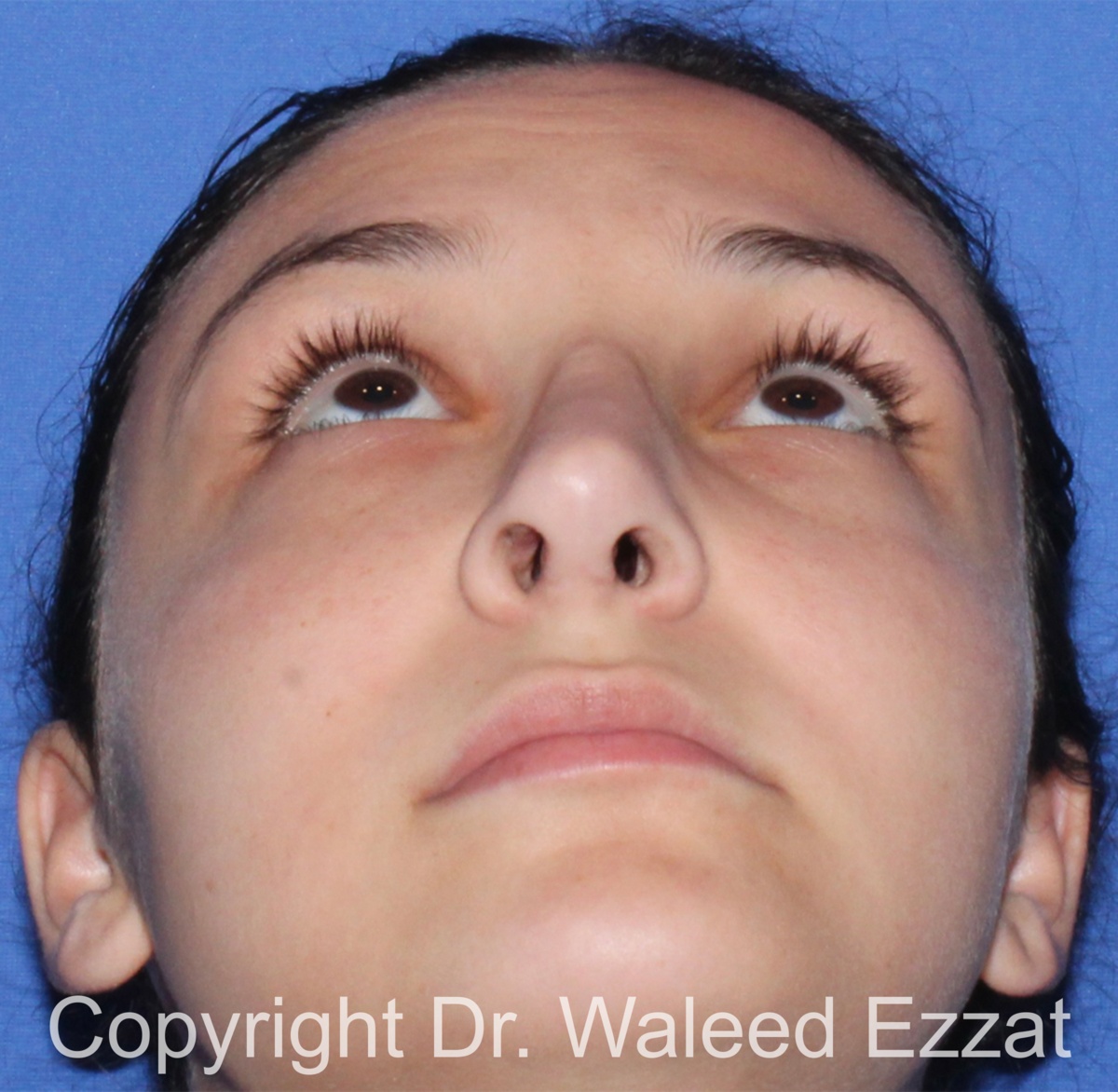 Revision Rhinoplasty Patient Photo - Case 515 - after view-3