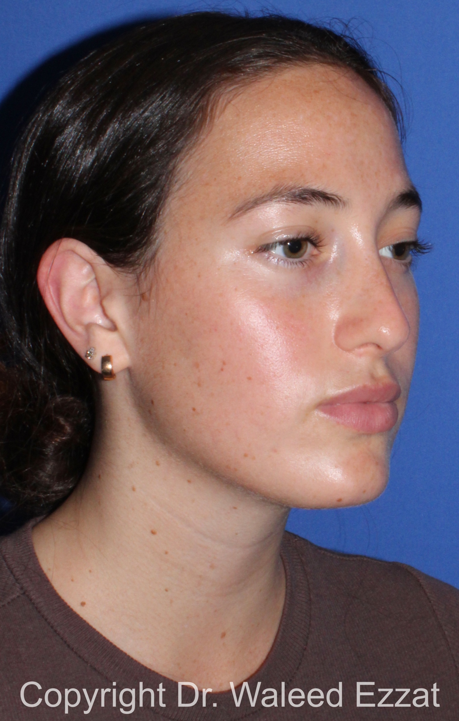Revision Rhinoplasty Patient Photo - Case 516 - before view-1