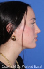 Revision Rhinoplasty - Case 516 - After