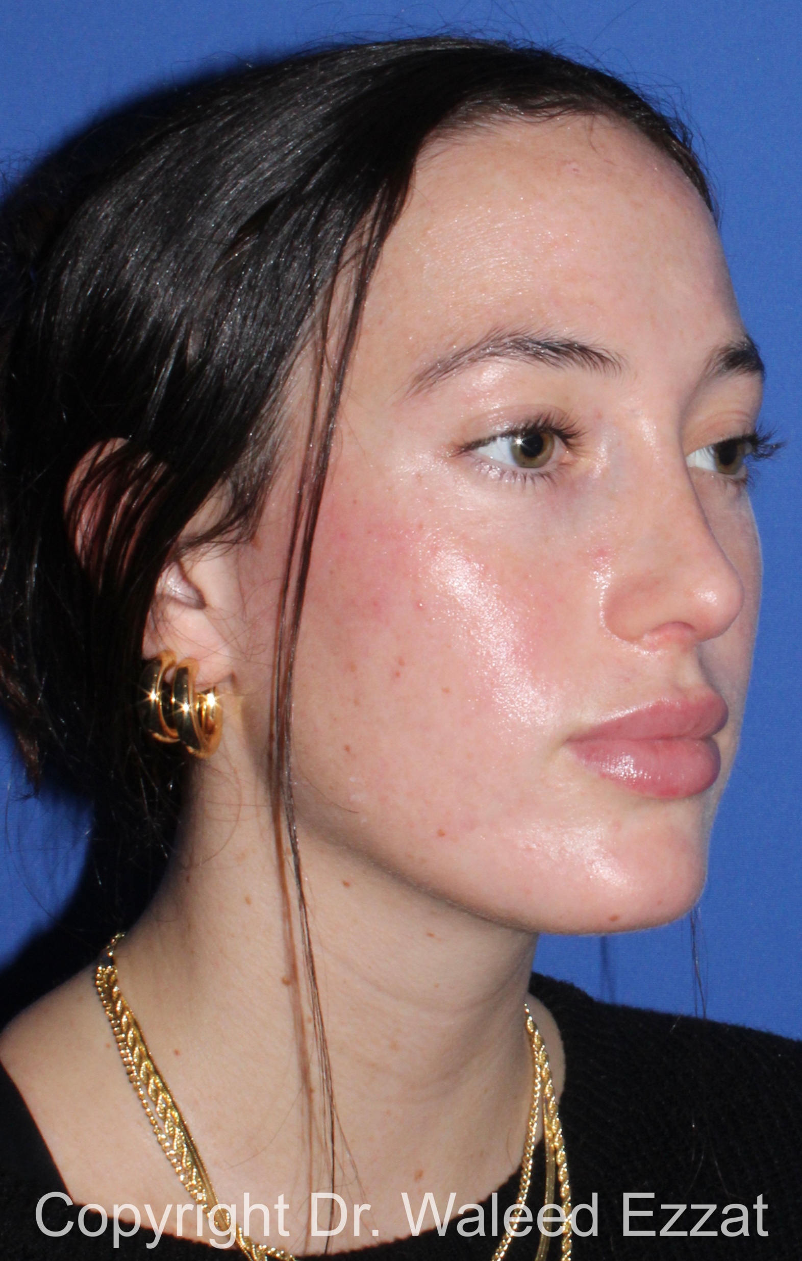 Revision Rhinoplasty Patient Photo - Case 516 - after view-1