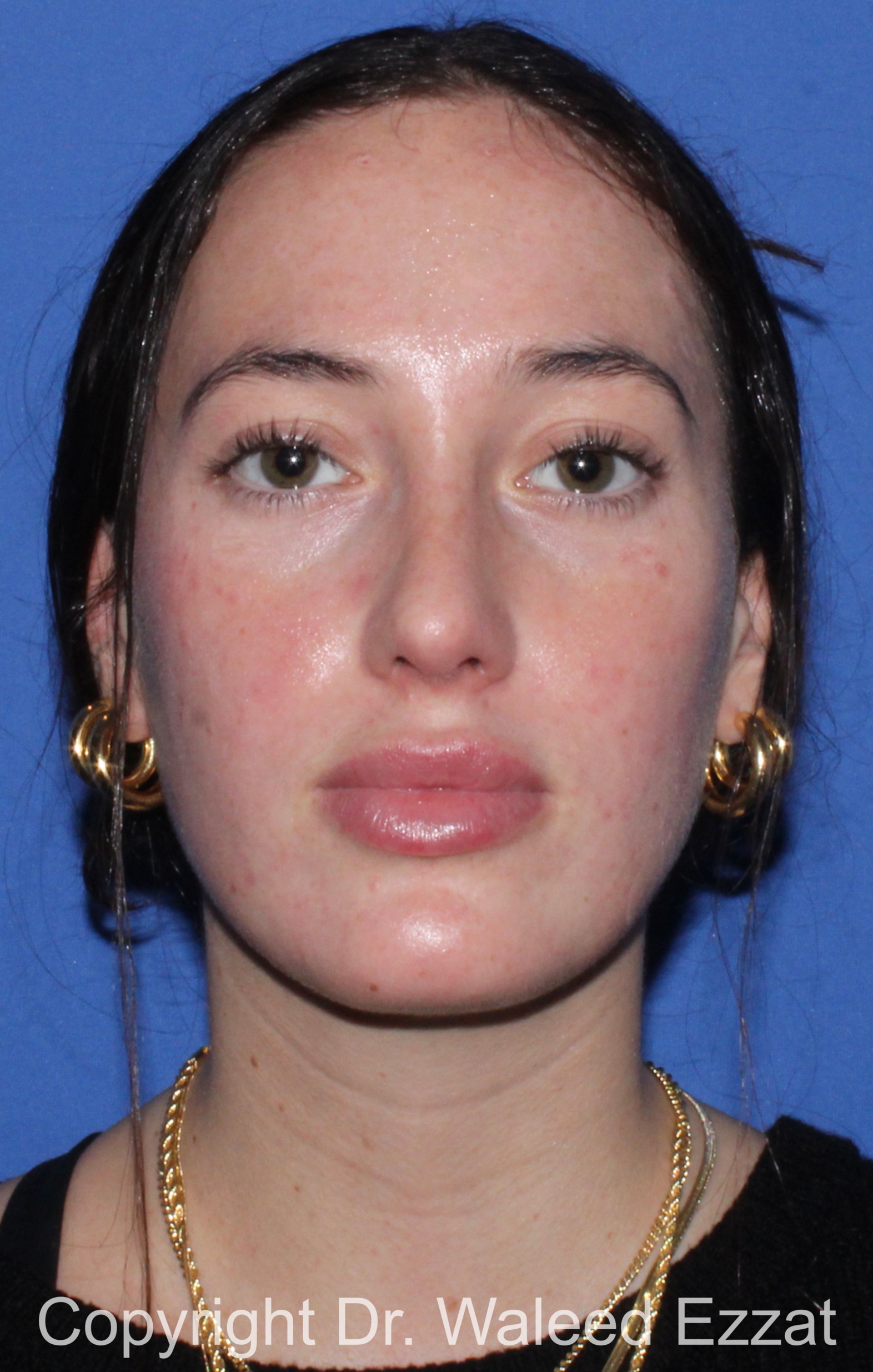 Revision Rhinoplasty Patient Photo - Case 516 - after view-2