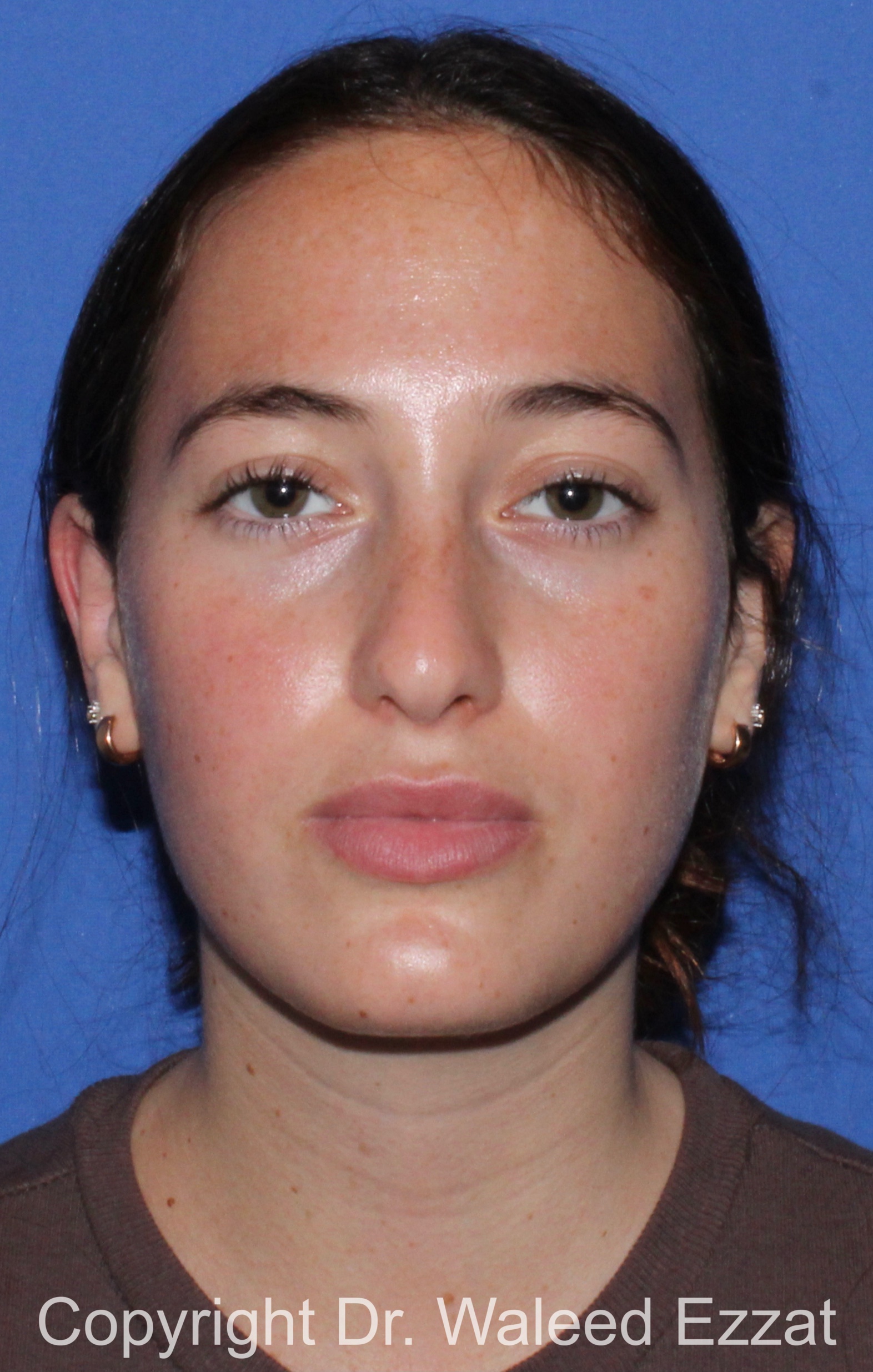 Revision Rhinoplasty Patient Photo - Case 516 - before view-2
