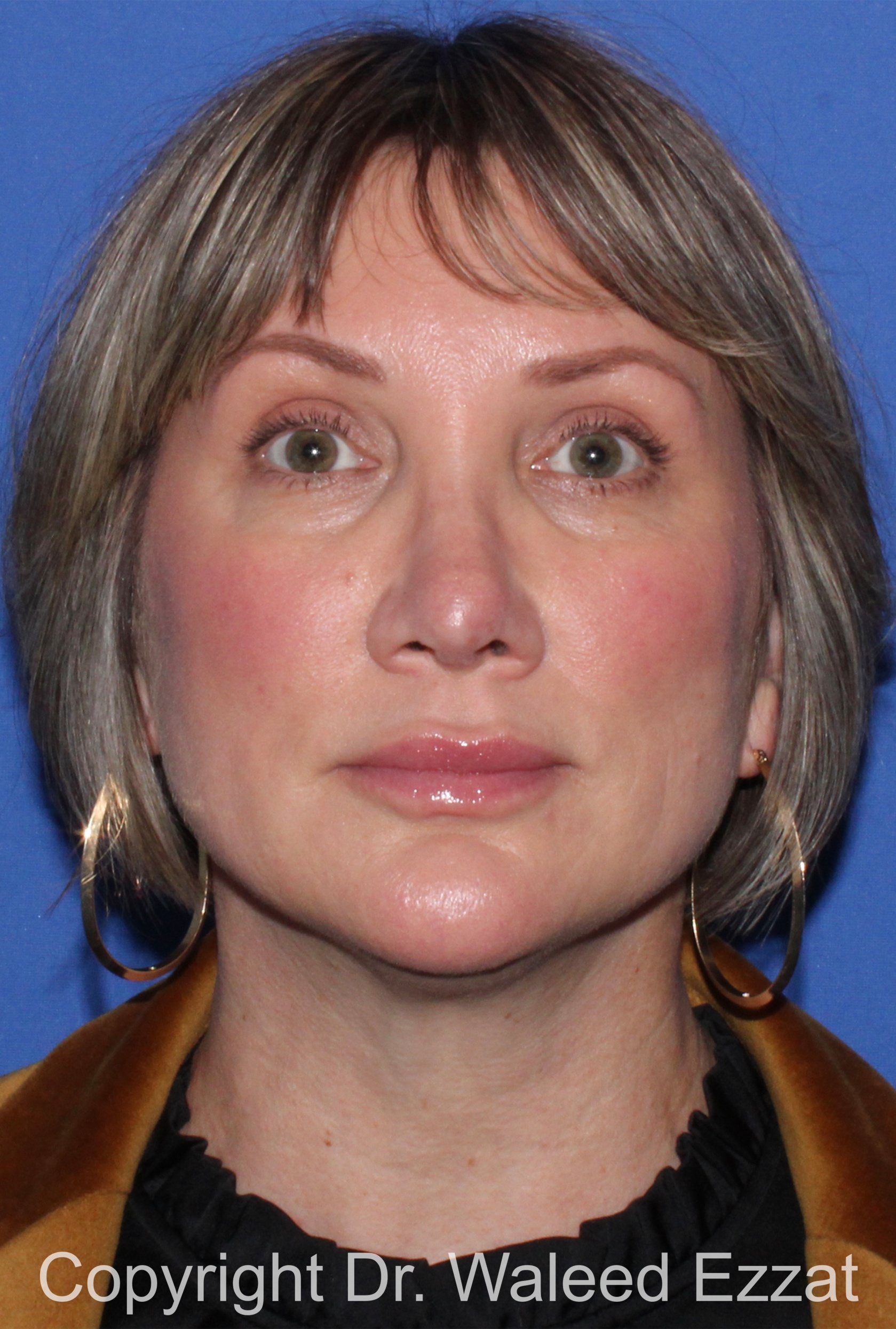 Revision Rhinoplasty Patient Photo - Case 517 - after view-2