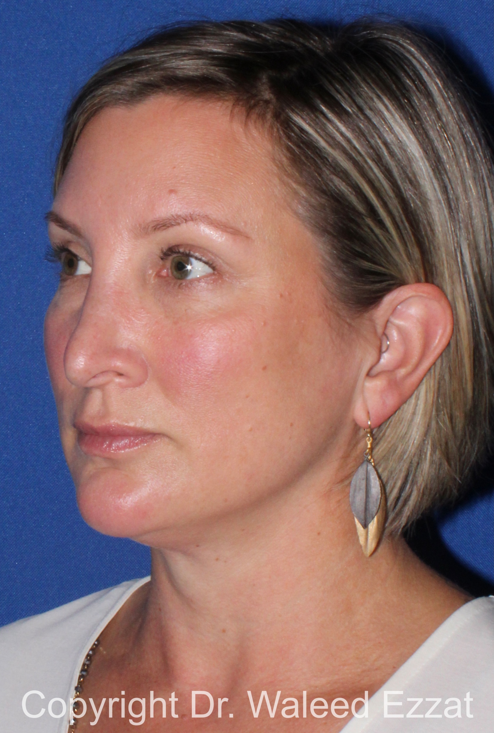 Revision Rhinoplasty Patient Photo - Case 517 - before view-1