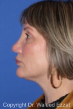 Revision Rhinoplasty - Case 517 - After