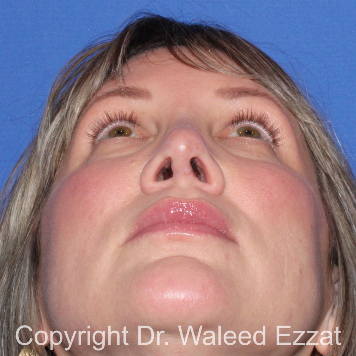 Revision Rhinoplasty Patient Photo - Case 517 - after view-3
