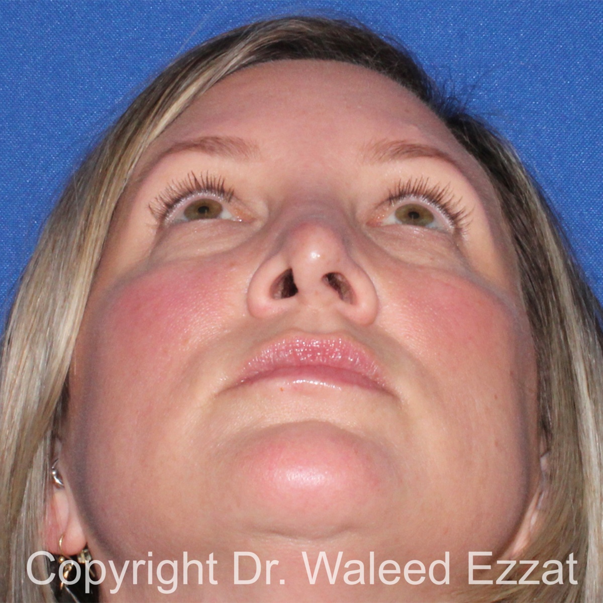 Revision Rhinoplasty Patient Photo - Case 517 - before view-3