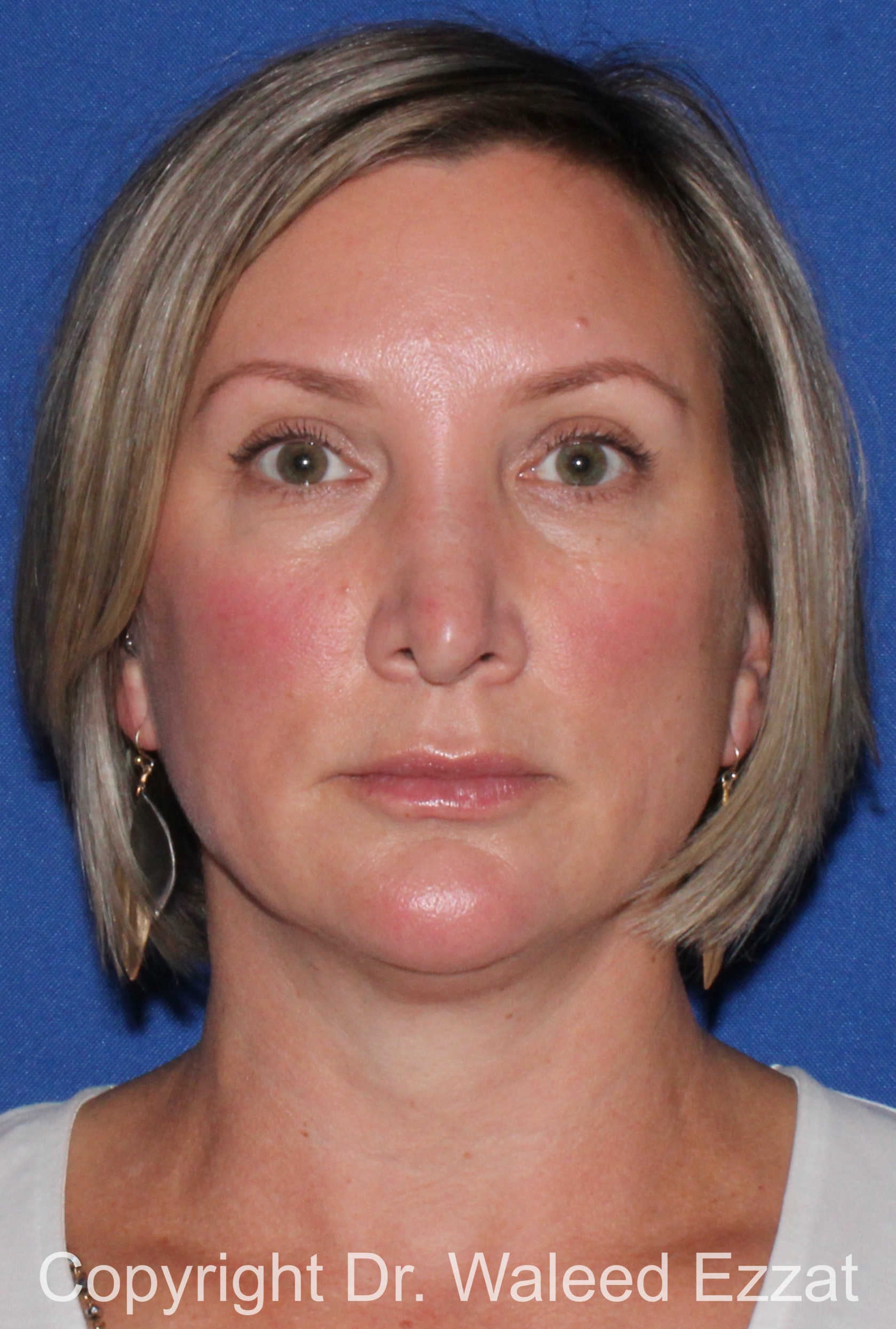 Revision Rhinoplasty Patient Photo - Case 517 - before view-2