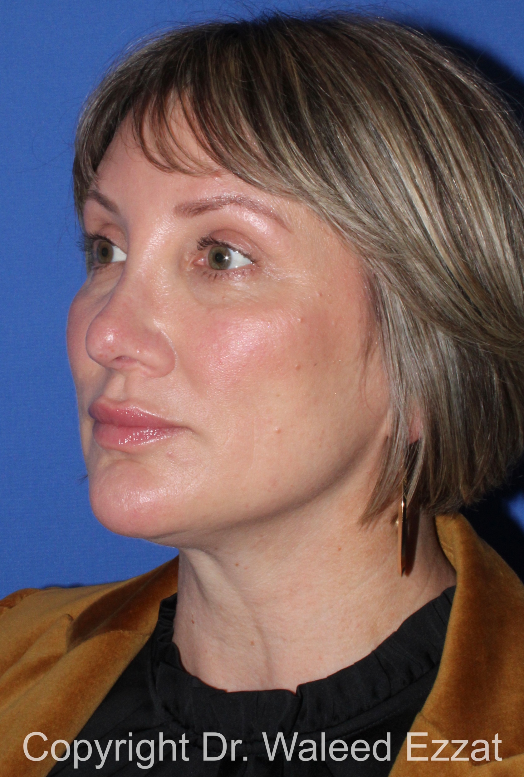 Revision Rhinoplasty Patient Photo - Case 517 - after view-1