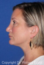 Revision Rhinoplasty - Case 517 - Before
