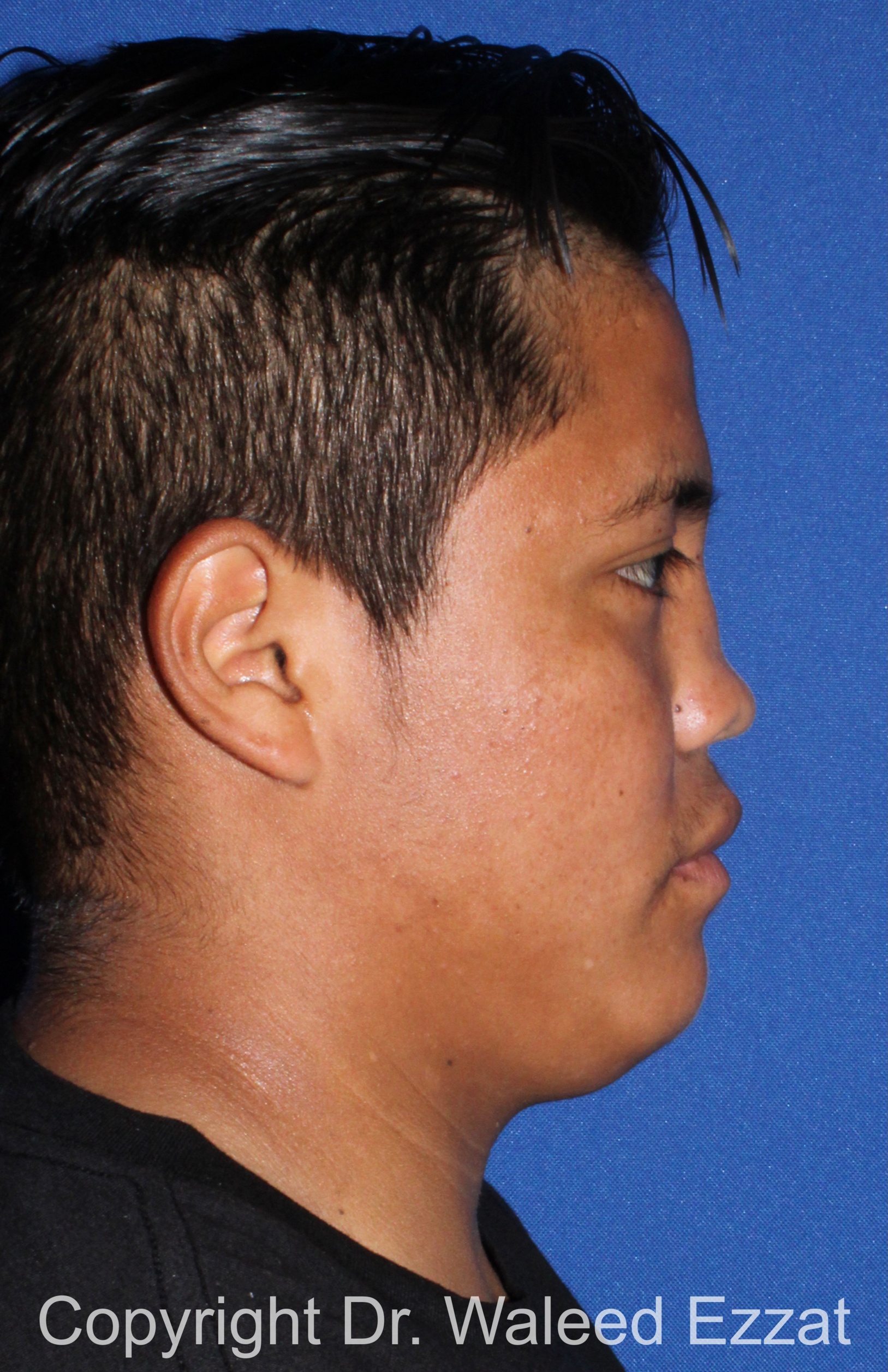 Reconstructive Rhinoplasty Patient Photo - Case 176 - before view-3