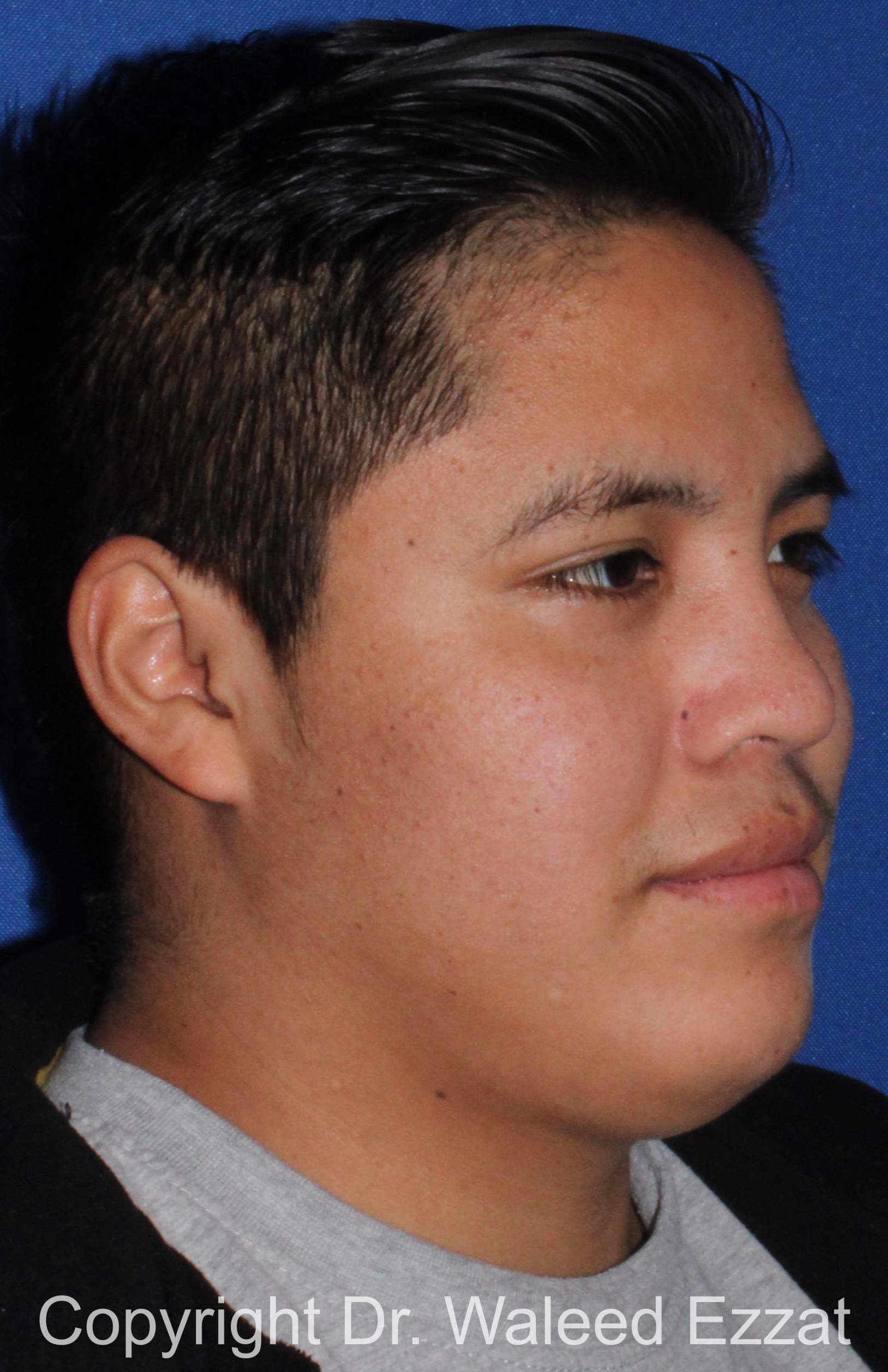 Reconstructive Rhinoplasty Patient Photo - Case 176 - after view-2