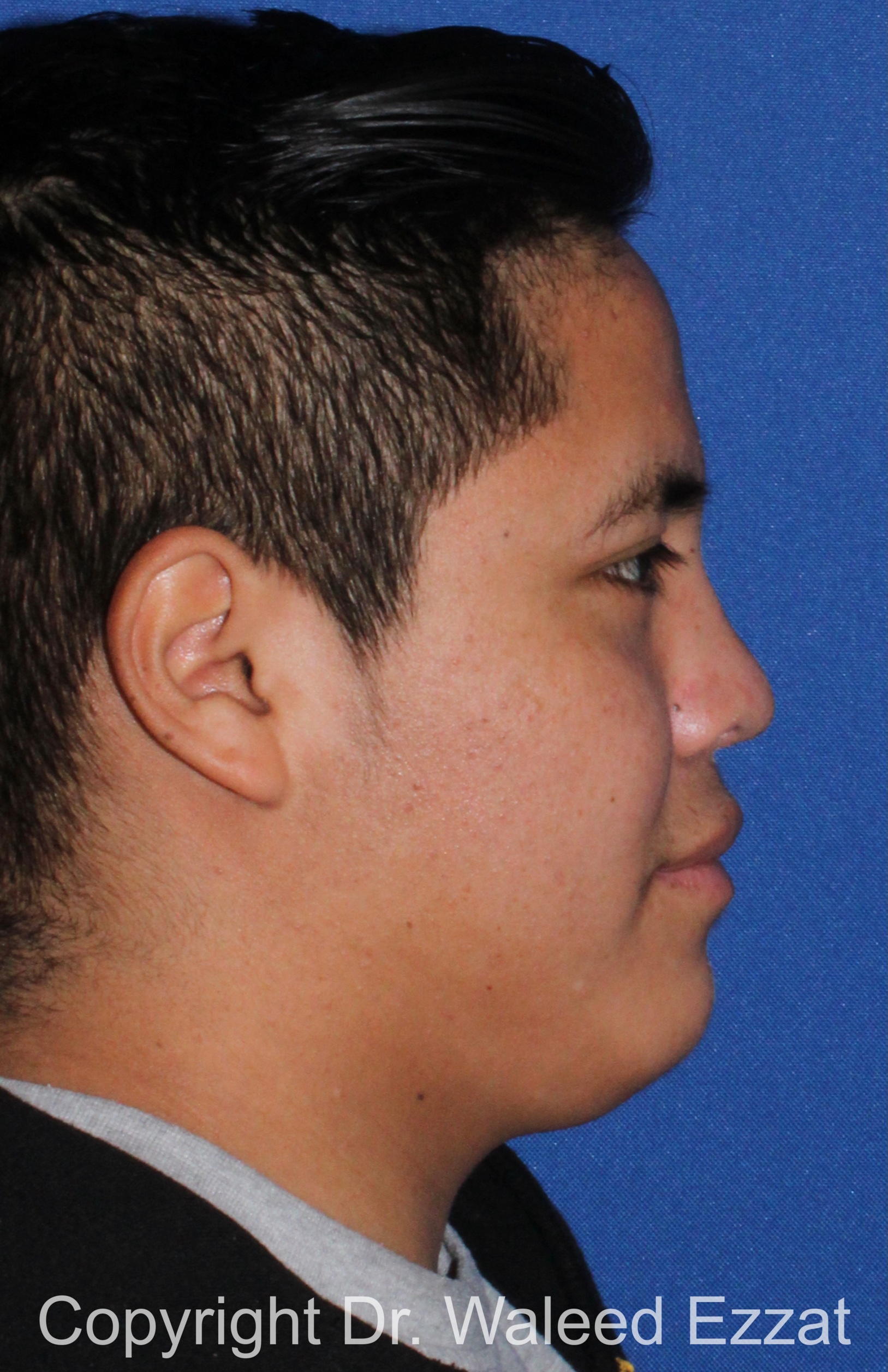 Reconstructive Rhinoplasty Patient Photo - Case 176 - after view-3