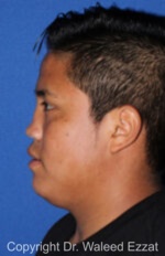 Reconstructive Rhinoplasty - Case 176 - Before