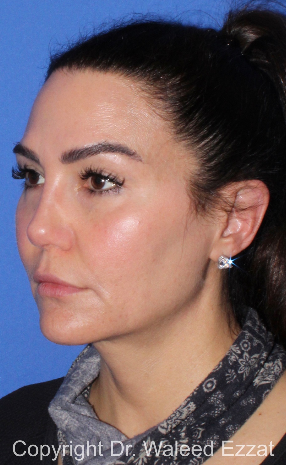 Revision Rhinoplasty Patient Photo - Case 518 - after view-1