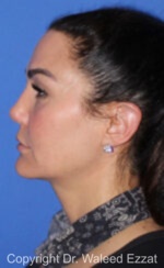 Revision Rhinoplasty - Case 518 - After