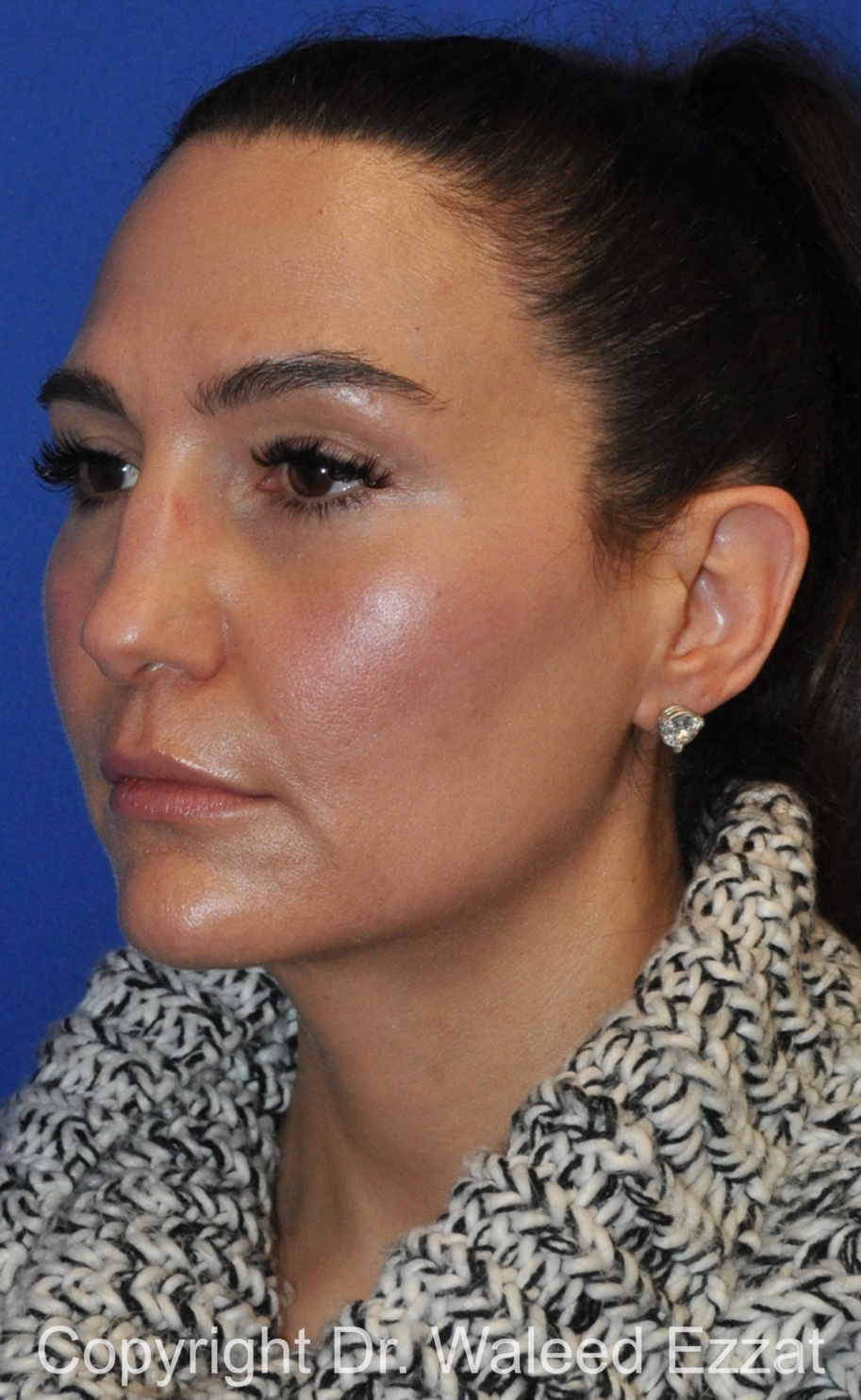Revision Rhinoplasty Patient Photo - Case 518 - before view-1