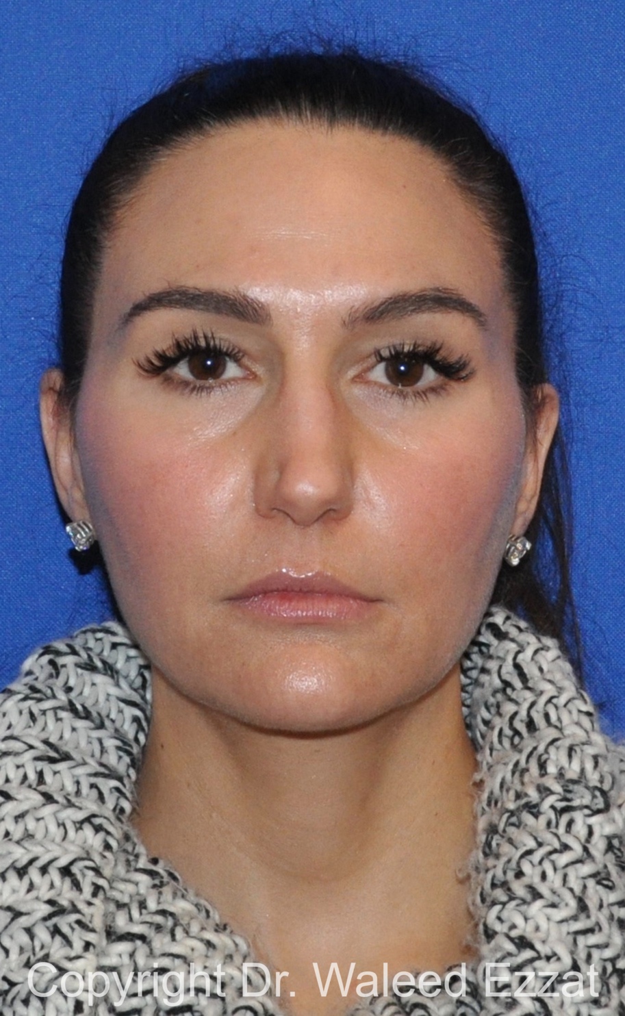 Revision Rhinoplasty Patient Photo - Case 518 - before view-2