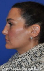 Revision Rhinoplasty - Case 518 - Before