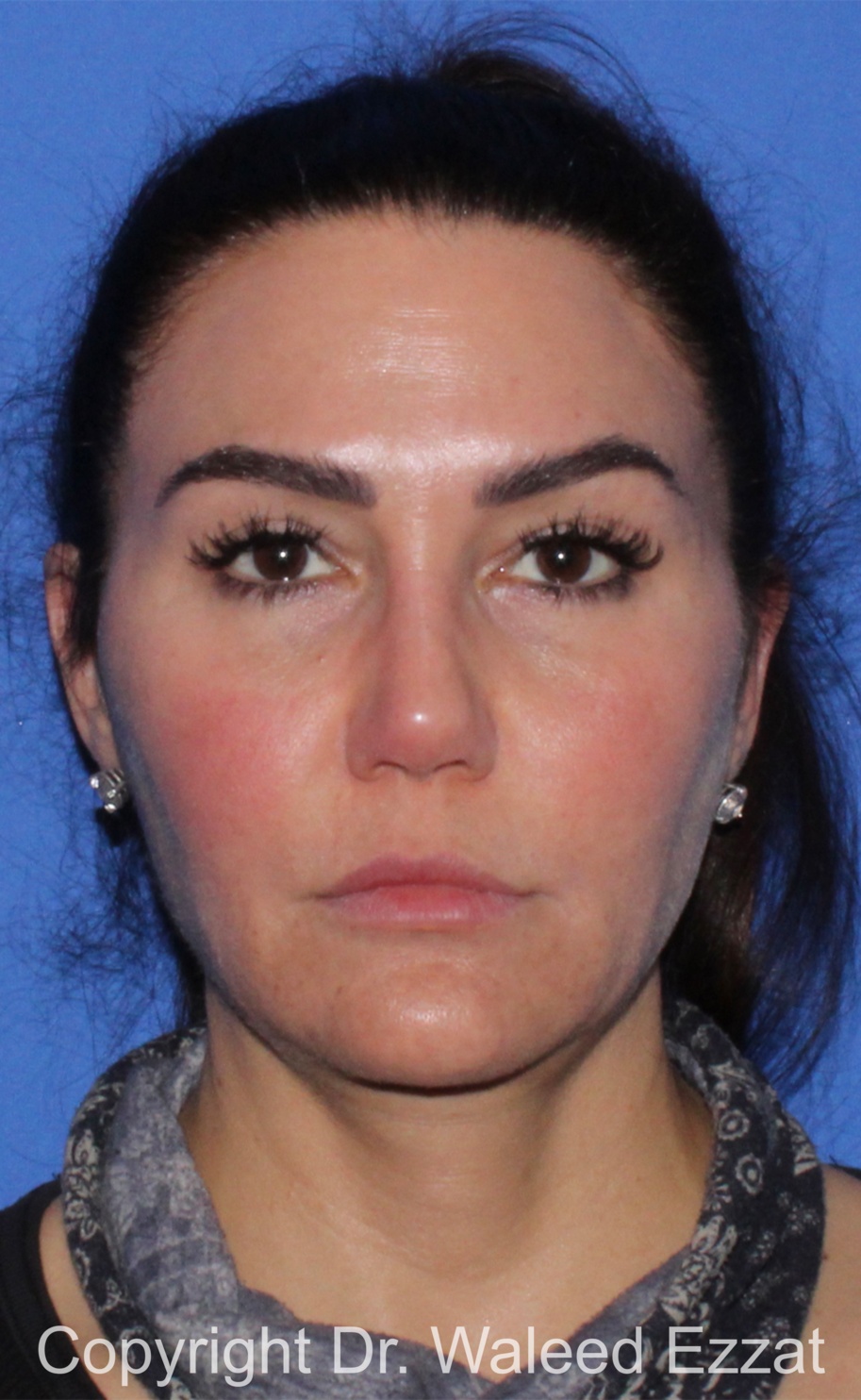 Revision Rhinoplasty Patient Photo - Case 518 - after view-2