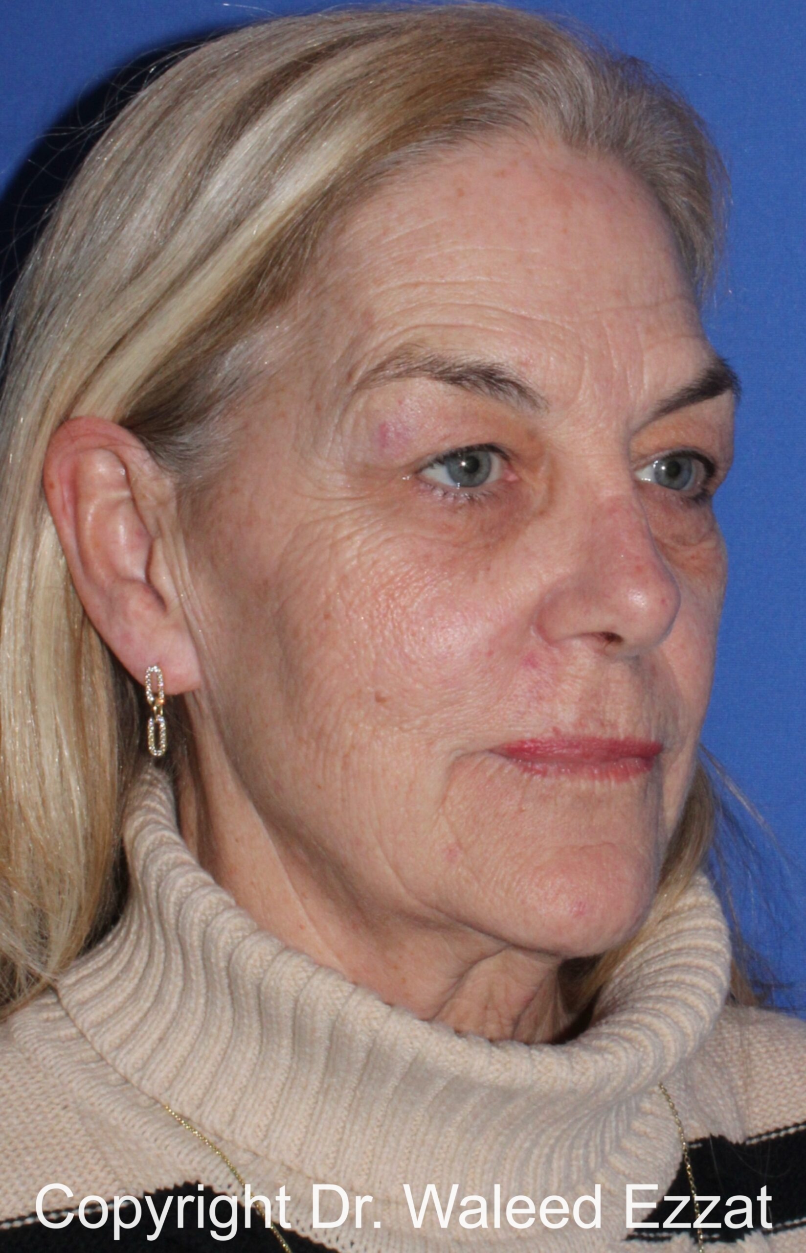 Brow Lift Patient Photo - Case 14 - before view-