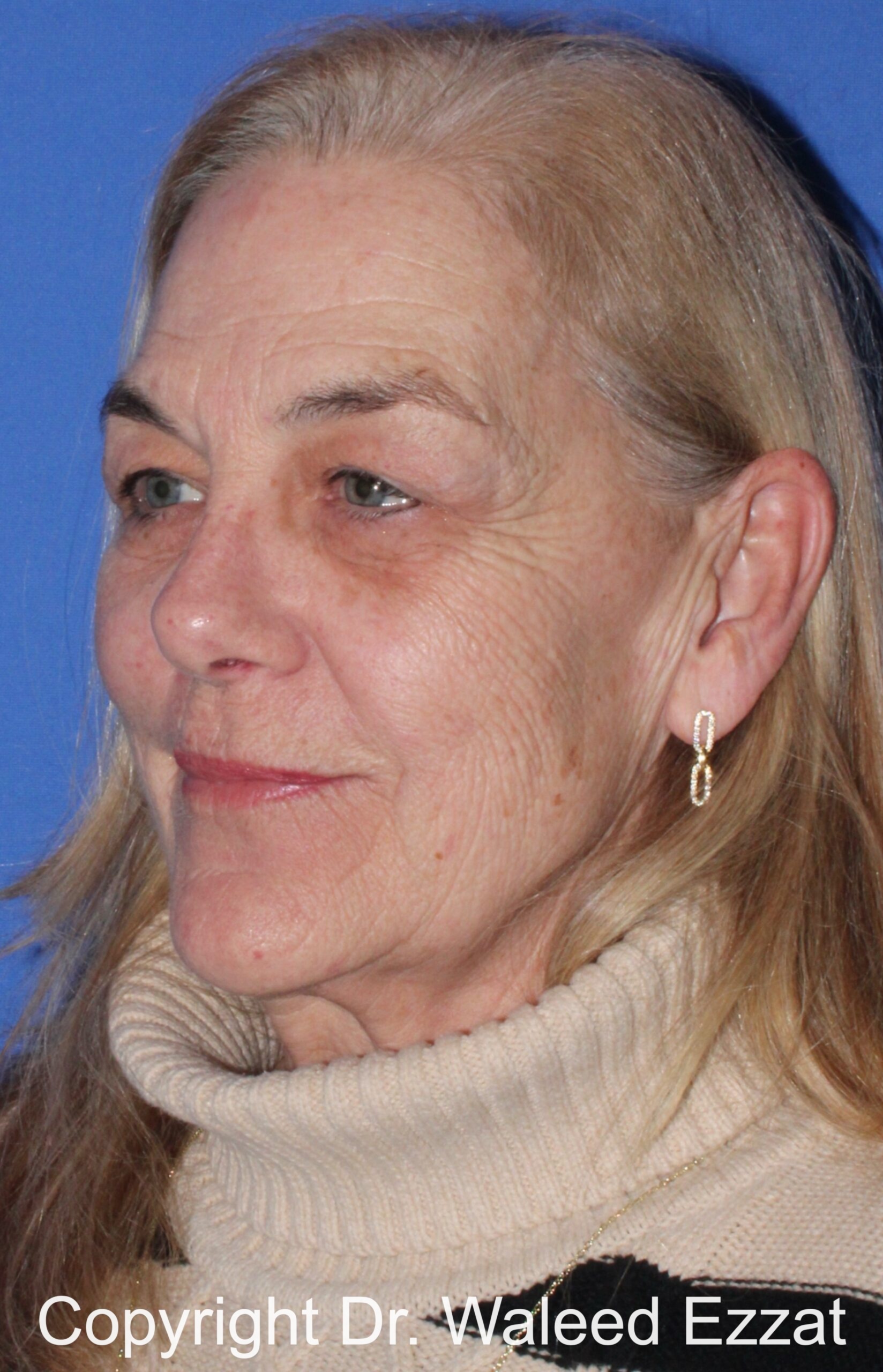 Brow Lift Patient Photo - Case 14 - before view-1