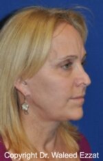 Brow Lift - Case 7 - Before