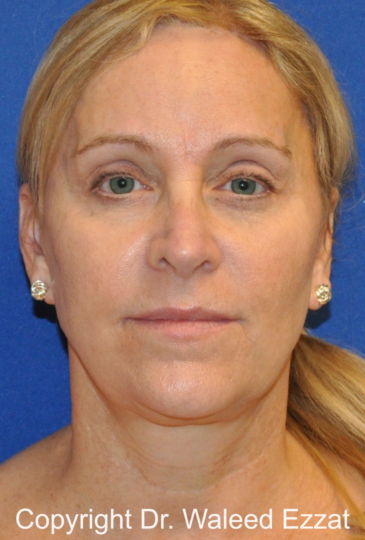 Brow Lift Patient Photo - Case 7 - after view-2