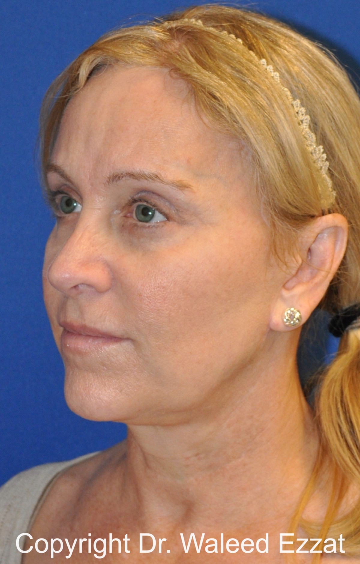 Brow Lift Patient Photo - Case 7 - after view-1