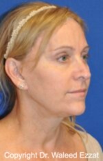 Brow Lift - Case 7 - After