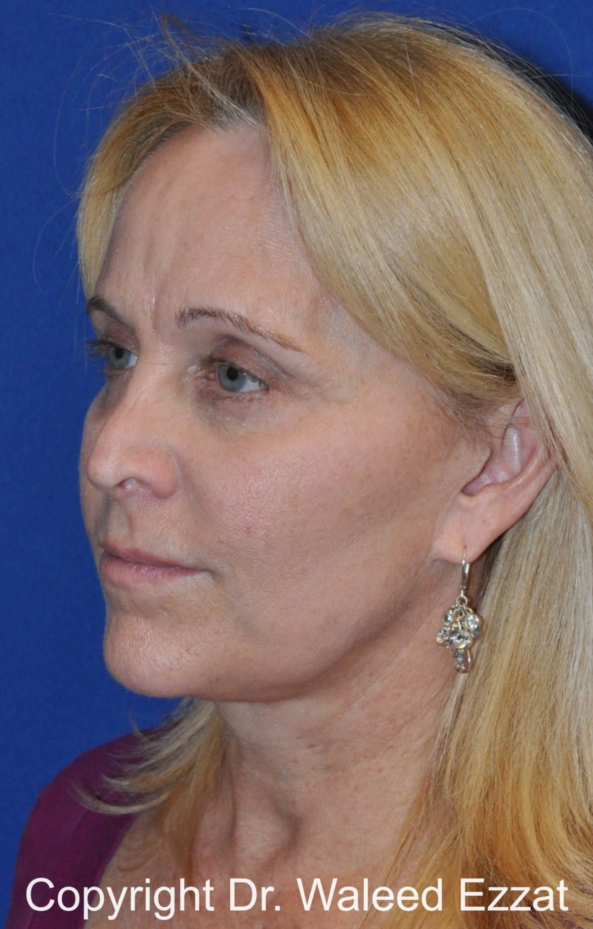 Brow Lift Patient Photo - Case 7 - before view-1