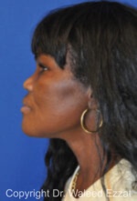 African/Caribbean Rhinoplasty - Case 203 - Before