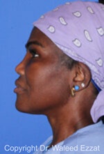African/Caribbean Rhinoplasty - Case 203 - After