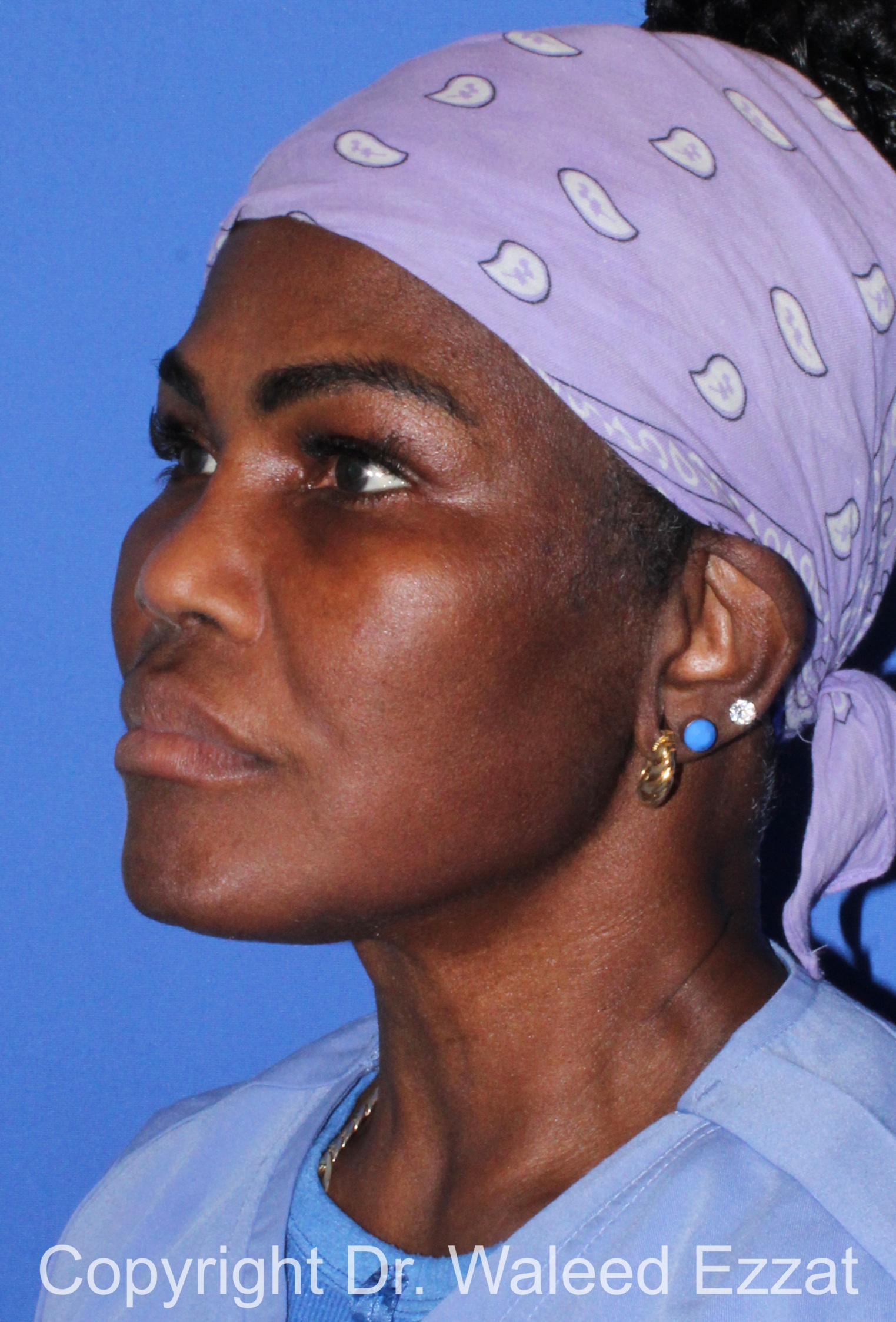 African/Caribbean Rhinoplasty Patient Photo - Case 203 - after view-1