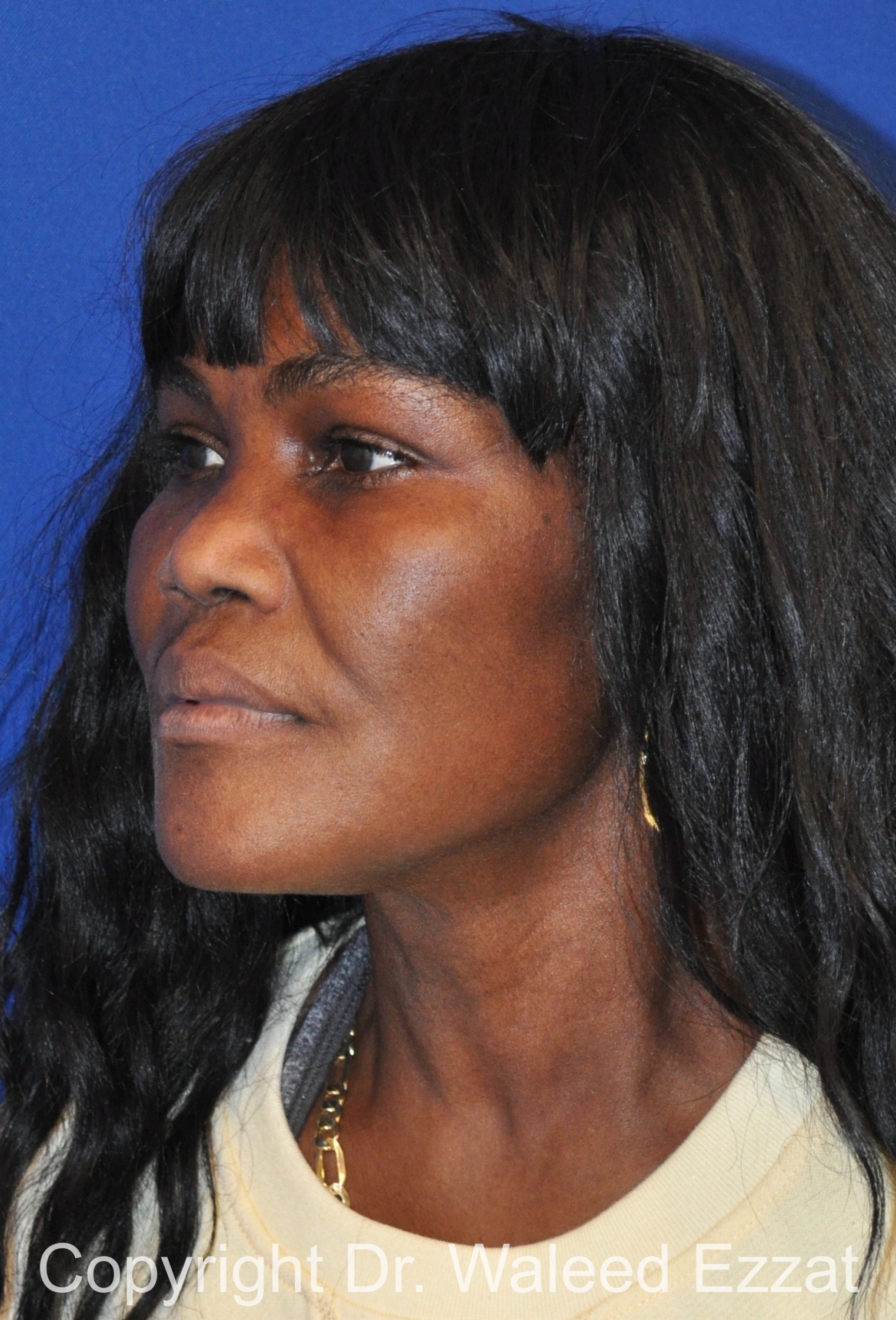 African/Caribbean Rhinoplasty Patient Photo - Case 203 - before view-1