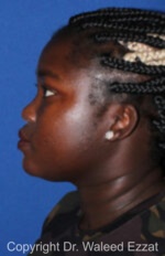 African/Caribbean Rhinoplasty - Case 204 - Before