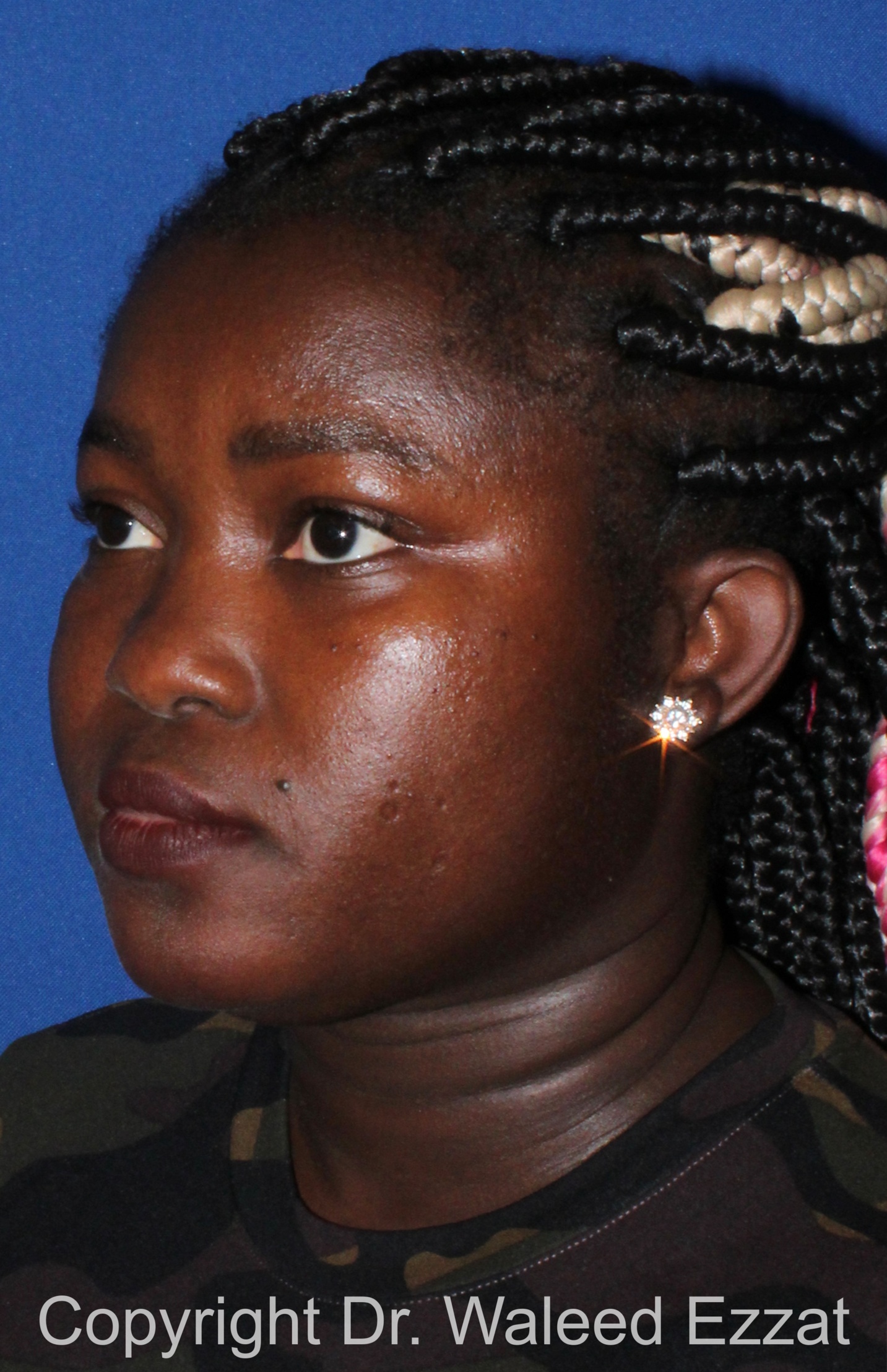 African/Caribbean Rhinoplasty Patient Photo - Case 204 - before view-1