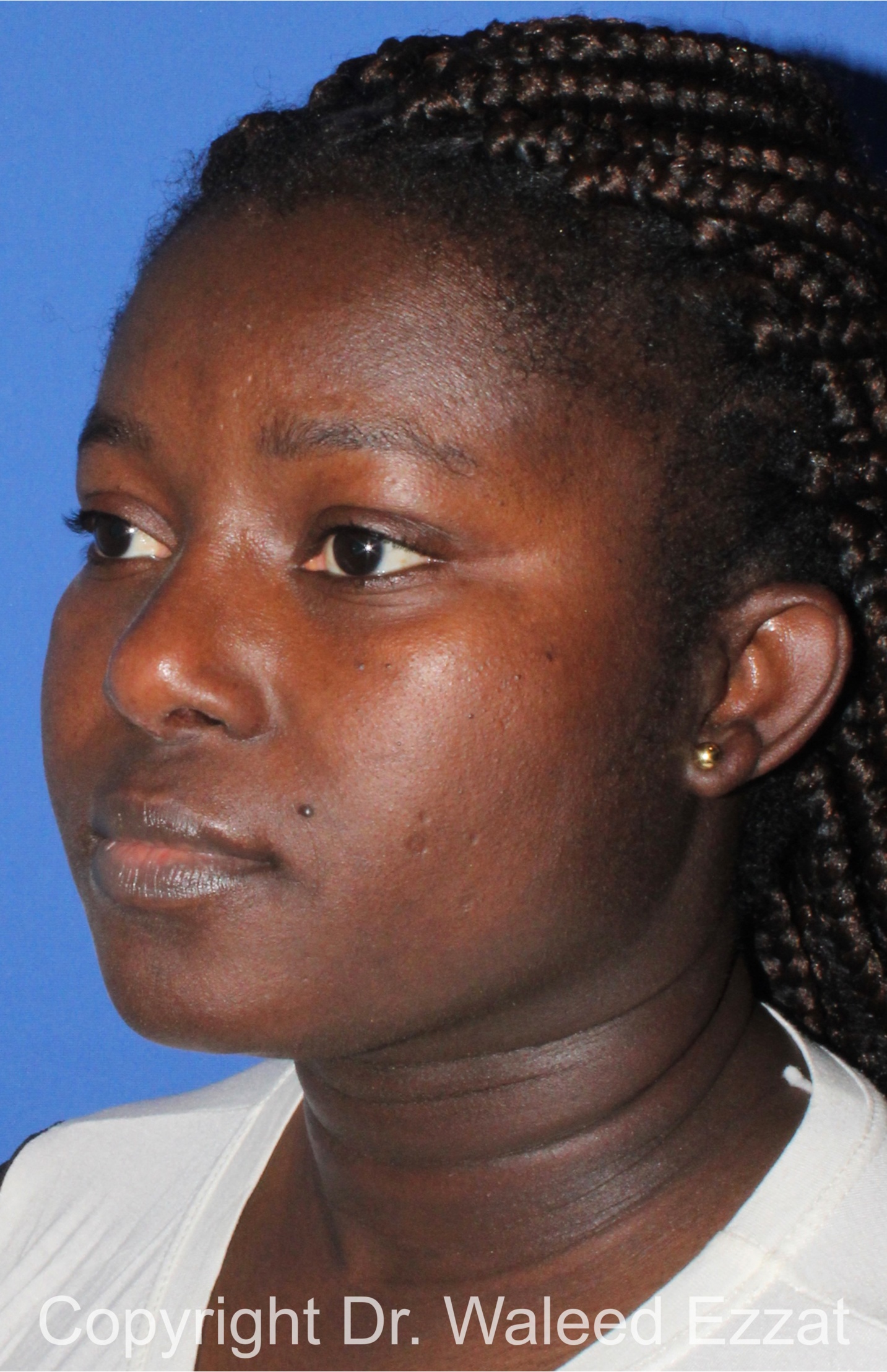 African/Caribbean Rhinoplasty Patient Photo - Case 204 - after view-1