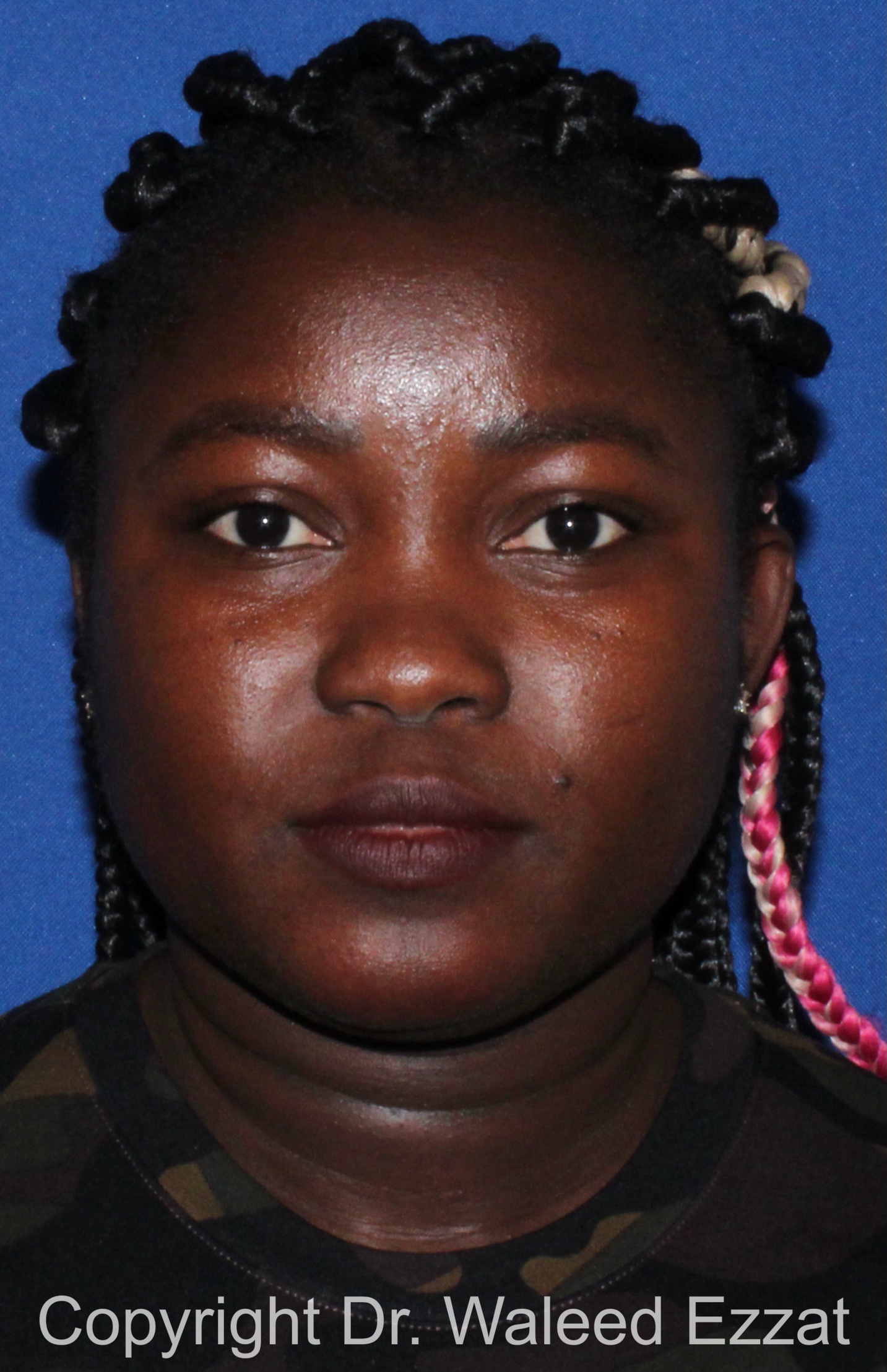 African/Caribbean Rhinoplasty Patient Photo - Case 204 - before view-2