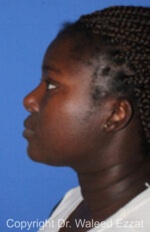 African/Caribbean Rhinoplasty - Case 204 - After